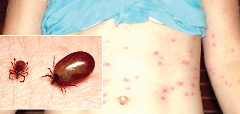 कोरोना महामारीका बीच चितवनमा १६५ जनामा स्क्रबटाइफस