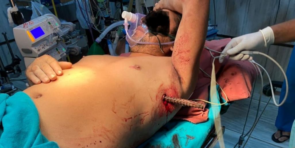 कोरोना संक्रमितको छातीमा १२ इन्चको रड सफलता पूर्वक निकालियो
